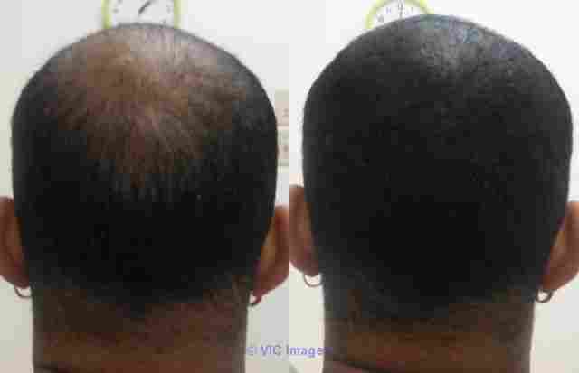  SMP Transplant Scar Repair & Camouflage|Hair treatment clinic in onta