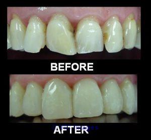 Cerec Restorations - Tooth Filling and Restoration @063555273