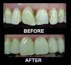 Waterlase – Laser Treatment  @063555273