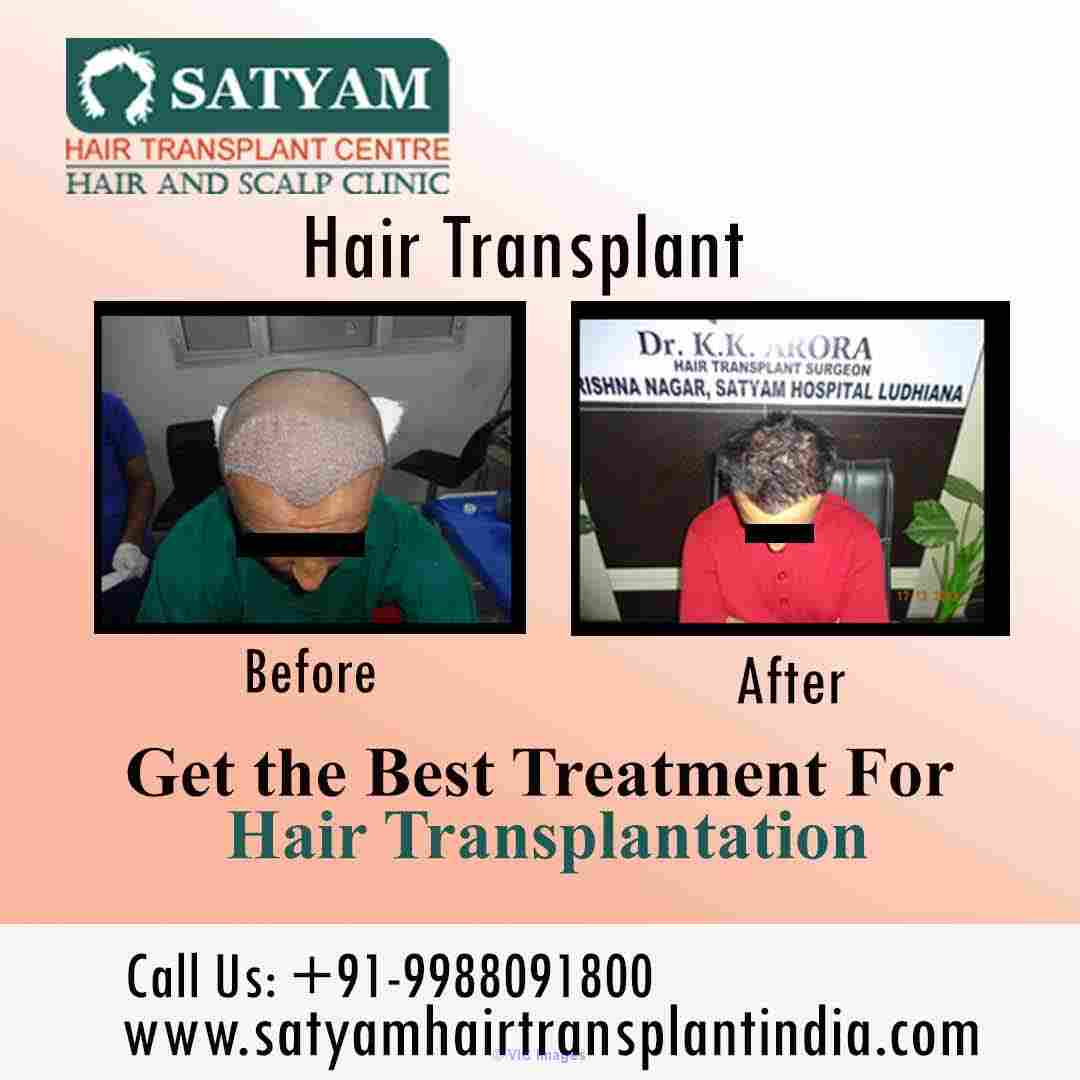 FUE Hair Transplant Clinic in India