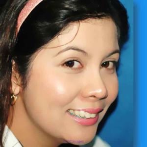 Rhinoplasty (Noselift) Philippines