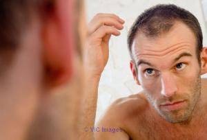  Effective Hair Transplant Clinic in Delhi 