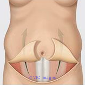 Tummy Tuck Montreal - Docteurchirurgieplastique