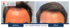 Hair Transplant in India | Indo Canadian Hair Transplant