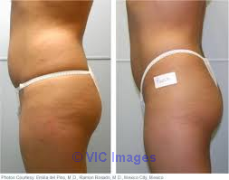 Cellulite Reduction Toronto