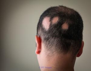 Get Ayurvedic Treatment for Alopecia at Himalayan Wellness Retreats