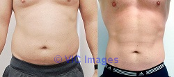 Fat removal cost Etobicoke