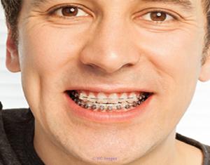 Best Invisible Braces in Calgary at Affordable Rates