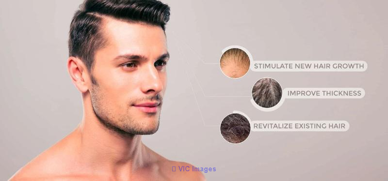 Best Hair Loss Clinic Toronto