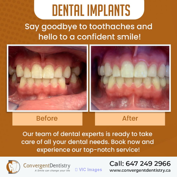 Tooth Extractions in Toronto
