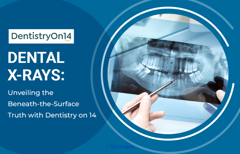 Dental X-Rays Markham