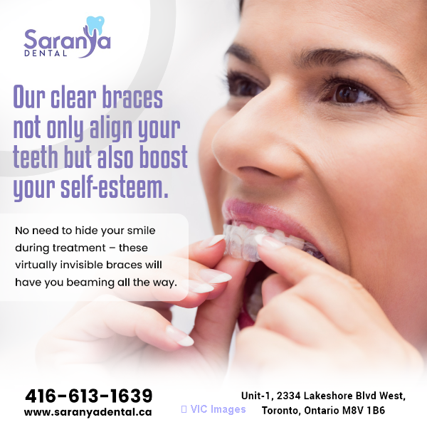teeth Whitening in Etobicoke