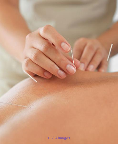 IMS Dry Needling in Surrey