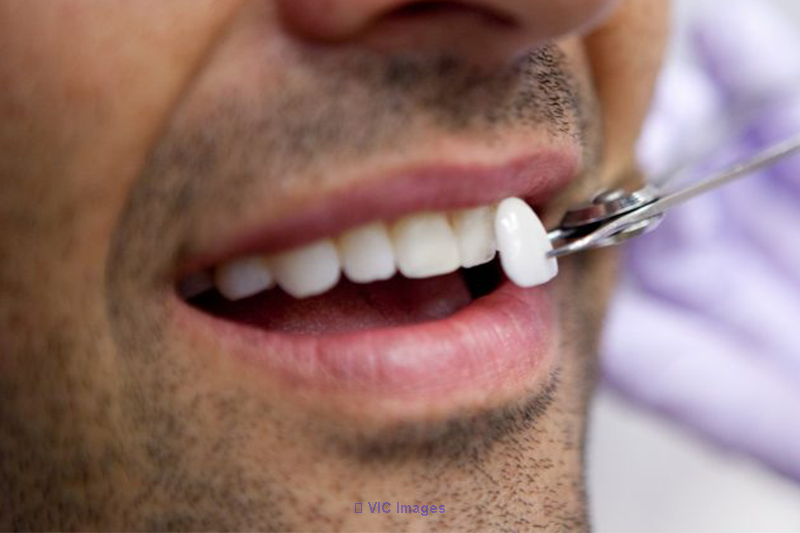 Dental Veneers in Woodbridge