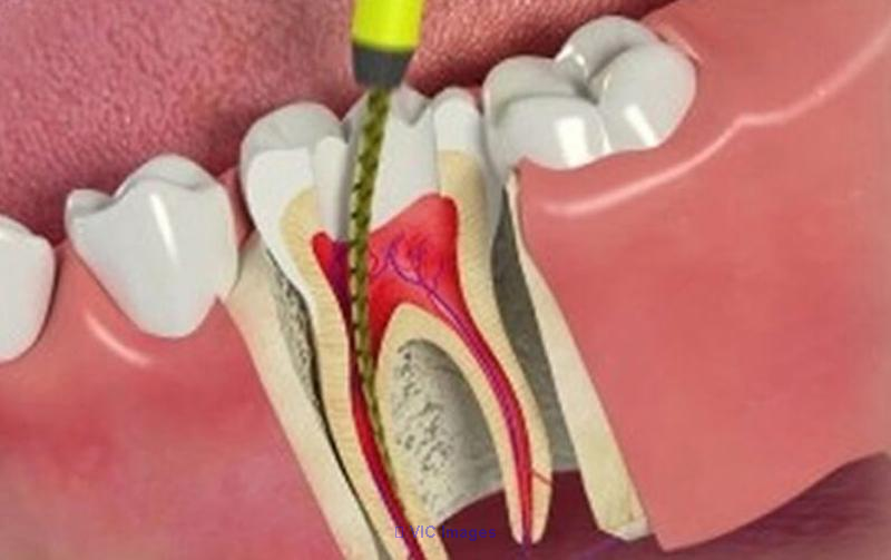 Root Canal Therapy in Toronto