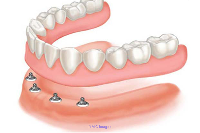 Implant Over Dentures in Woodbridge | Dental Specialists Group