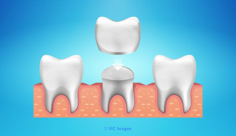 Dental Crowns in Toronto | Dental Crowns near Toronto