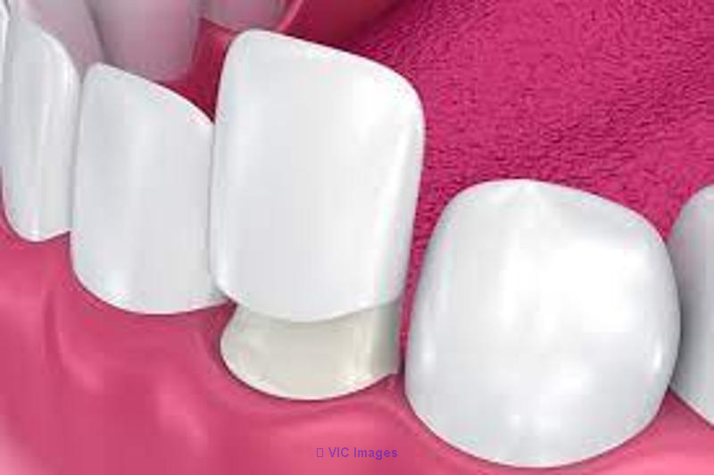 Dental Veneers In Toronto |