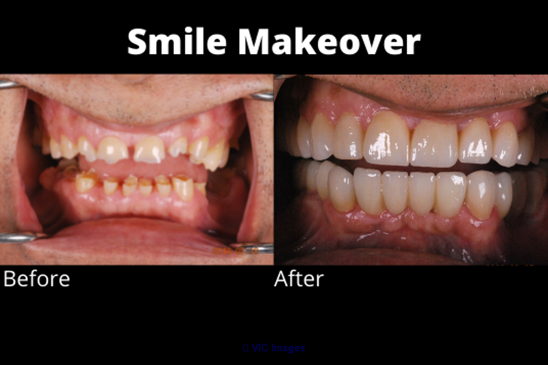 Smile Makeovers in Woodbridge | Full Mouth Restoration in Woodbridge