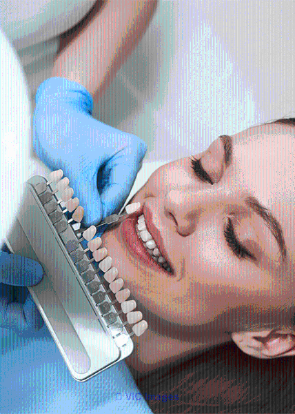 Porcelain Veneers in Mississauga | Porcelain Veneers in Brampton