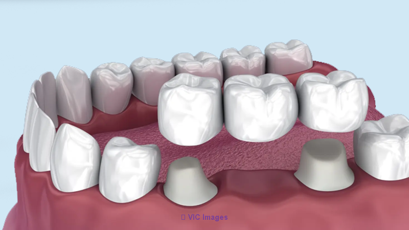 Dental Bridges Oakville | Replace Missing Teeth