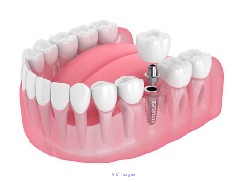 DENTAL IMPLANTS IN TORONTO