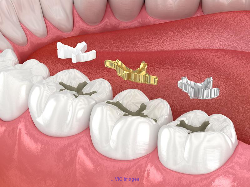 Tooth Filling Vancouver | Dental Filling Vancouver