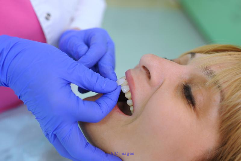 Porcelain Veneers Vancouver | Dental Veneers Vancouver