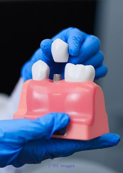 Dental Implants in Mississauga | Dental Implants in Brampton