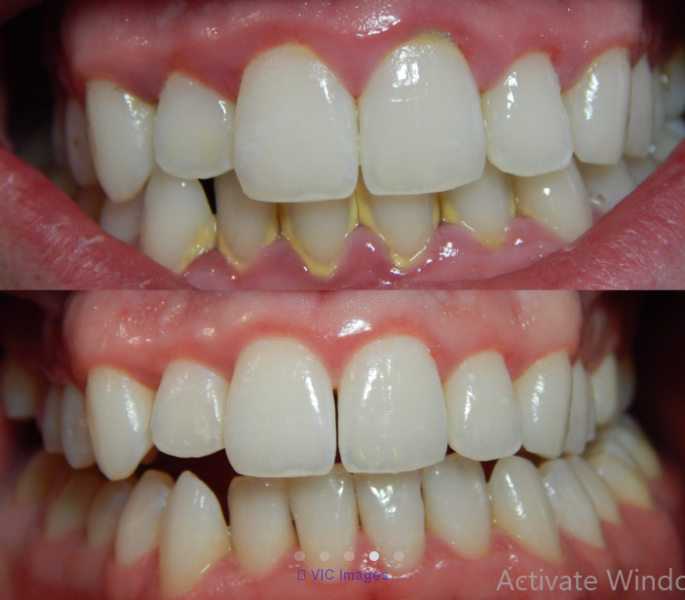 Dental Cleaning Burnaby | Teeth Cleaning Burnaby