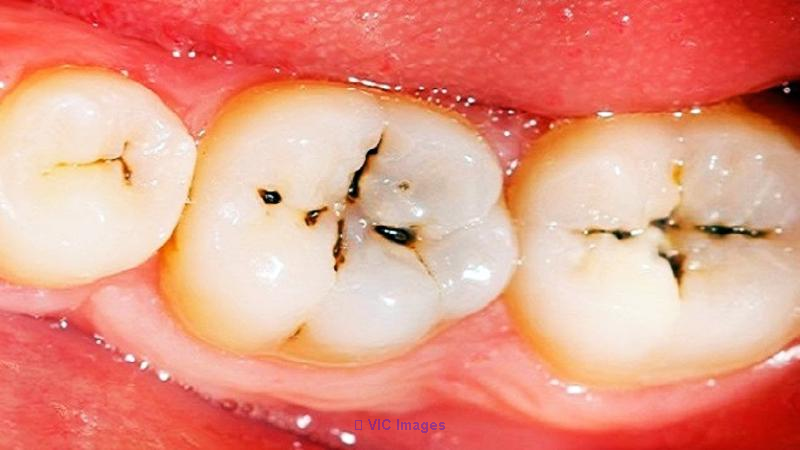 Dentist for Cavities, Call Metro City Dentistry Today!