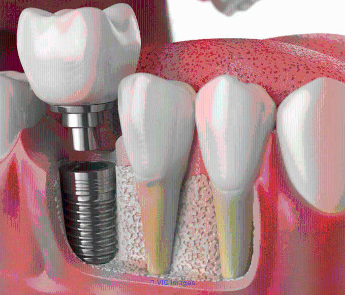 Dental Implants Markham