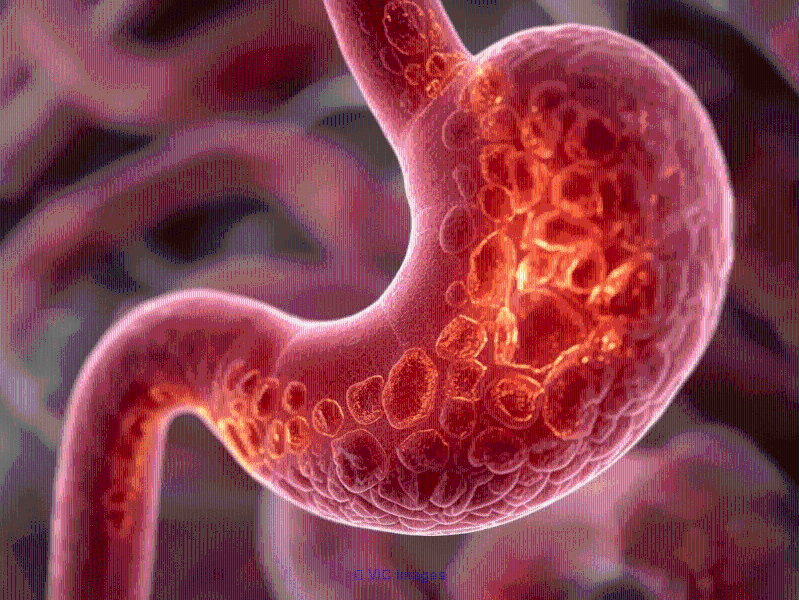 How Long to Take Gaviscon for GERD Your Essential Guide from Cloud Pha